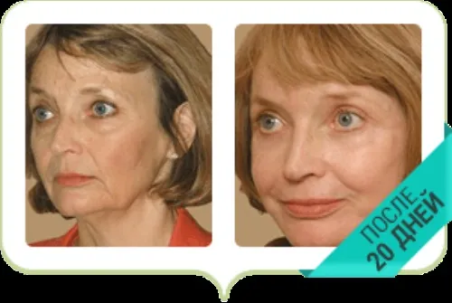 Dr botox : kompozisyon sadece doğal maddeler.
